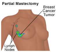 Illustration of a partial mastectomy
