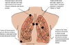Illustration of  tumor types and location in the lung