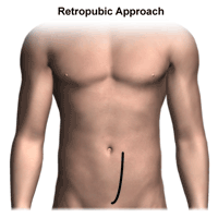 Illustration of retropubic approach to prostatectomy