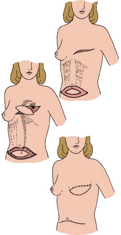 tram flap procedure